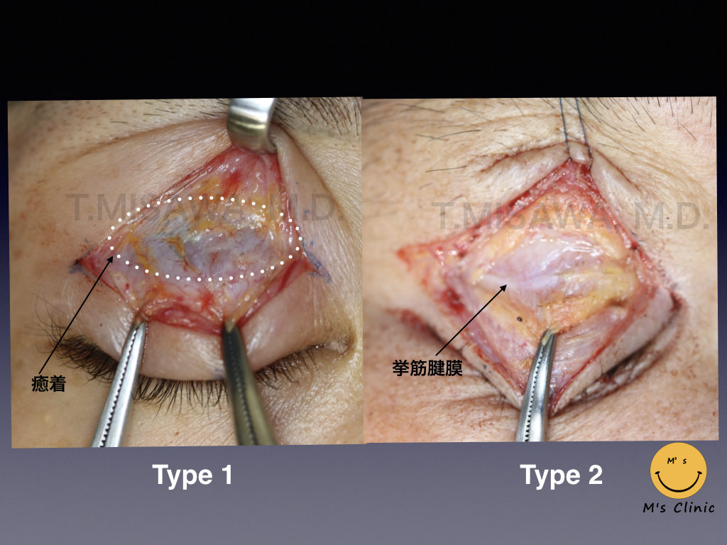 眼瞼下垂症の原因と他院修正（やり直し再手術）保険適用の2つの例